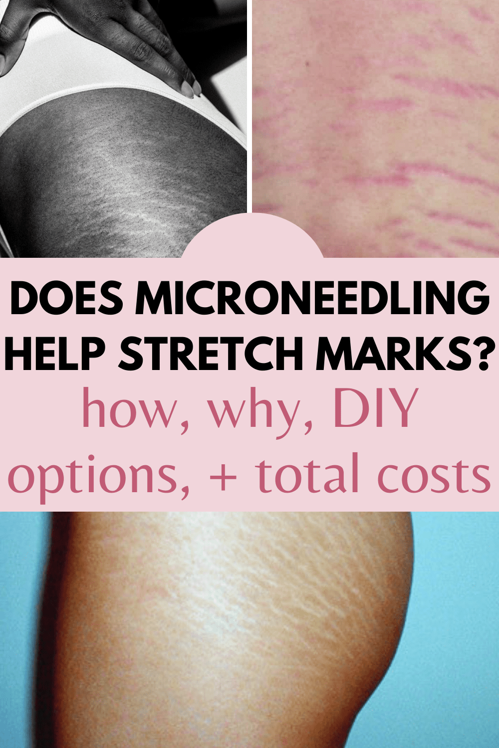 Does Microneedling Help Stretch Marks? [2024]