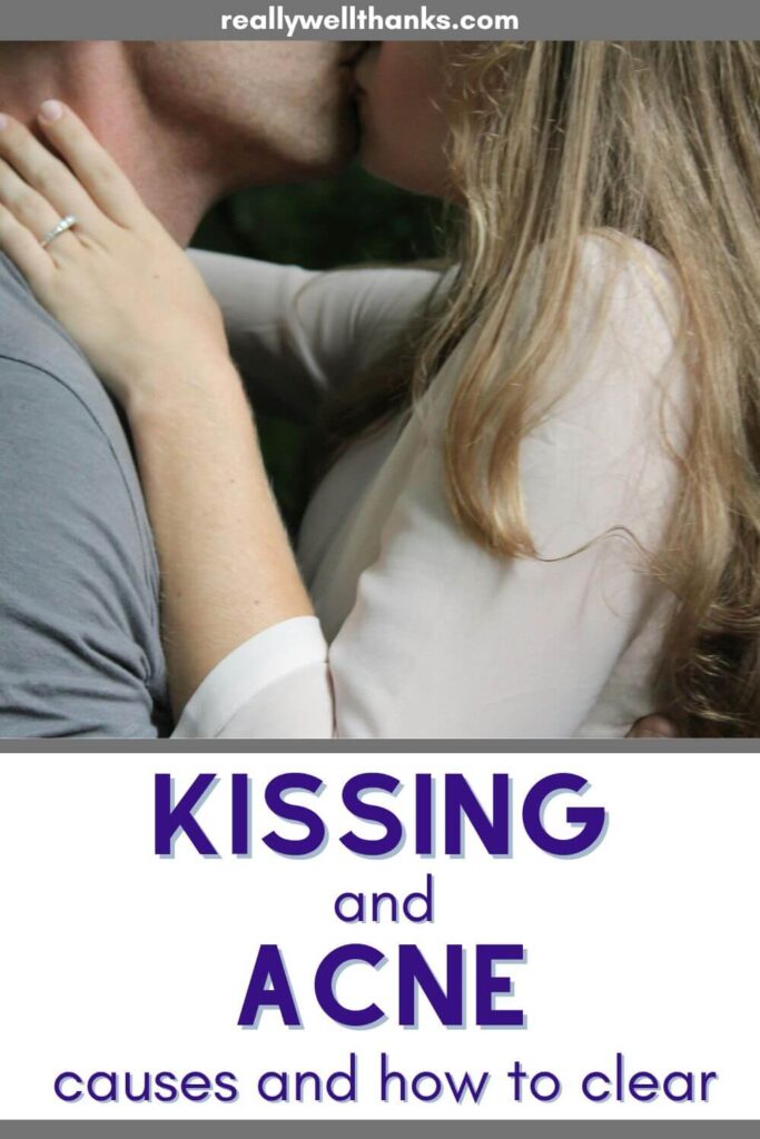 Can Kissing Cause Acne? Love and Breakouts really well, thanks!